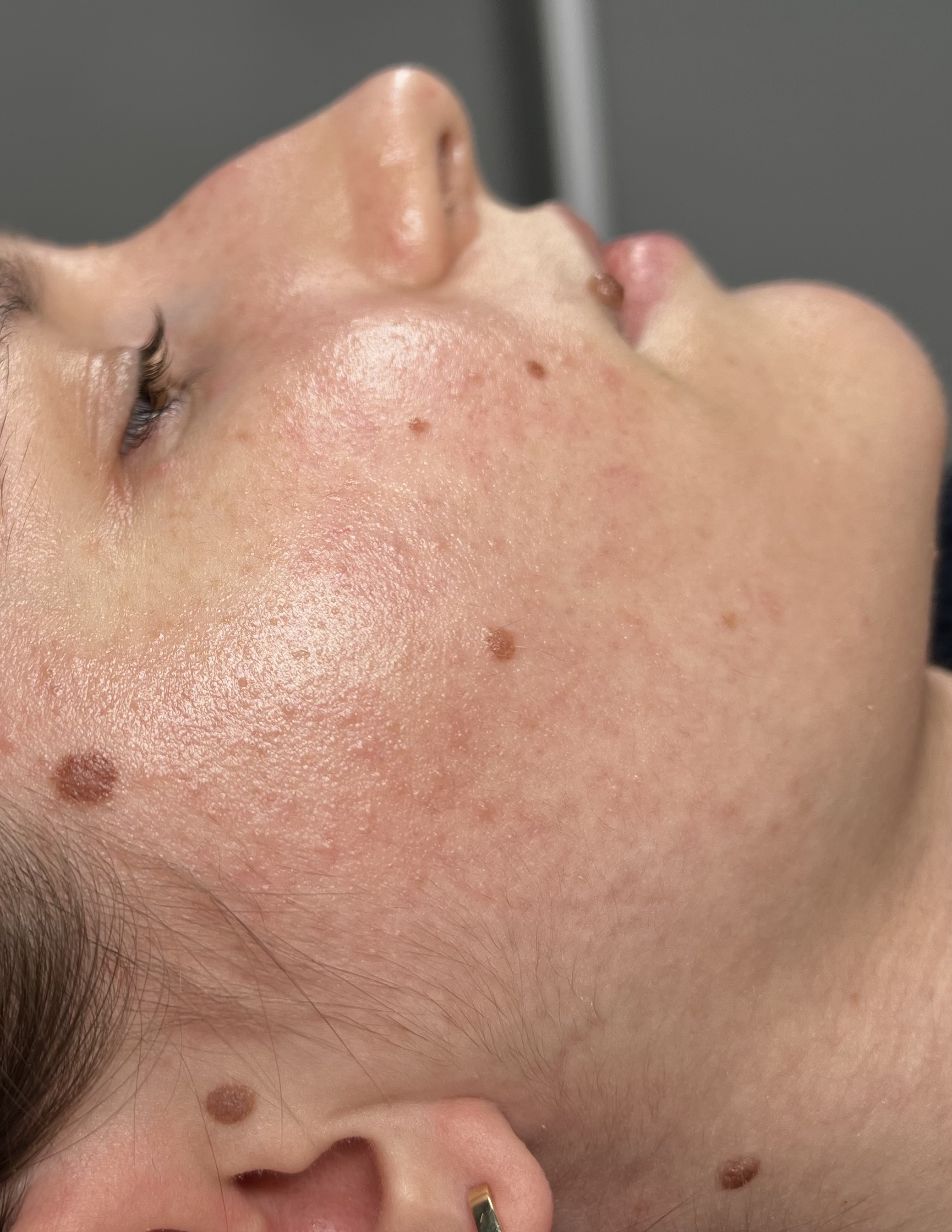 Bariera hydrolipidowa skóry - fundament skutecznej terapii dermatologicznej